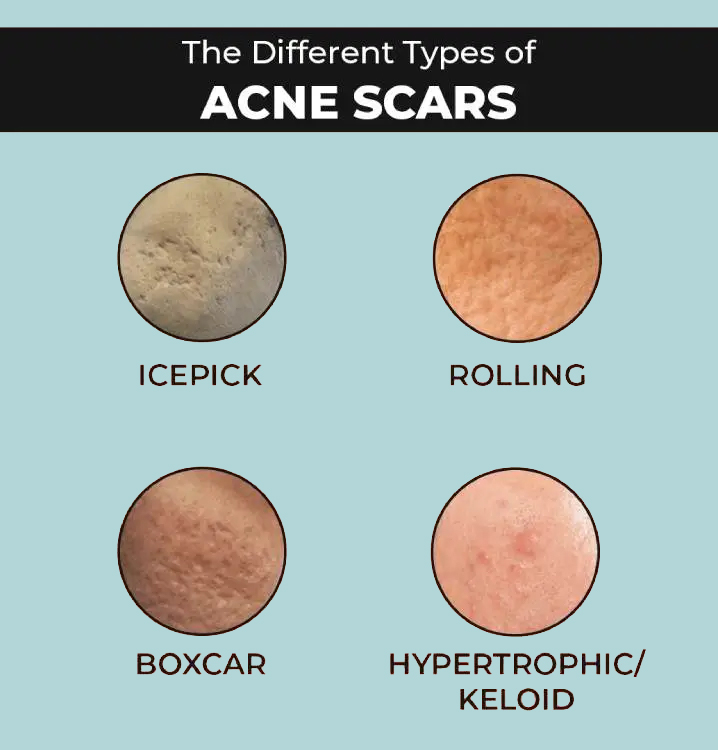 Types of Acne Scars: Icepick, Rolling, Boxcar, Hypertrophic/Keloid. Types of Acne Scar Treatment In Indore: Subcision, Chemical Peel